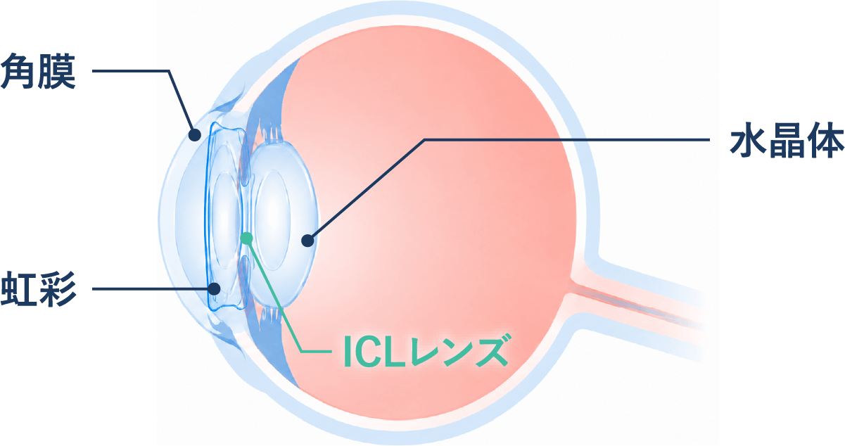 ICLレンズを目の中に入れる位置を示した図
